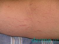 Estrias rubras