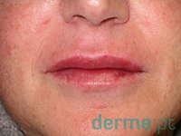 Labios depois