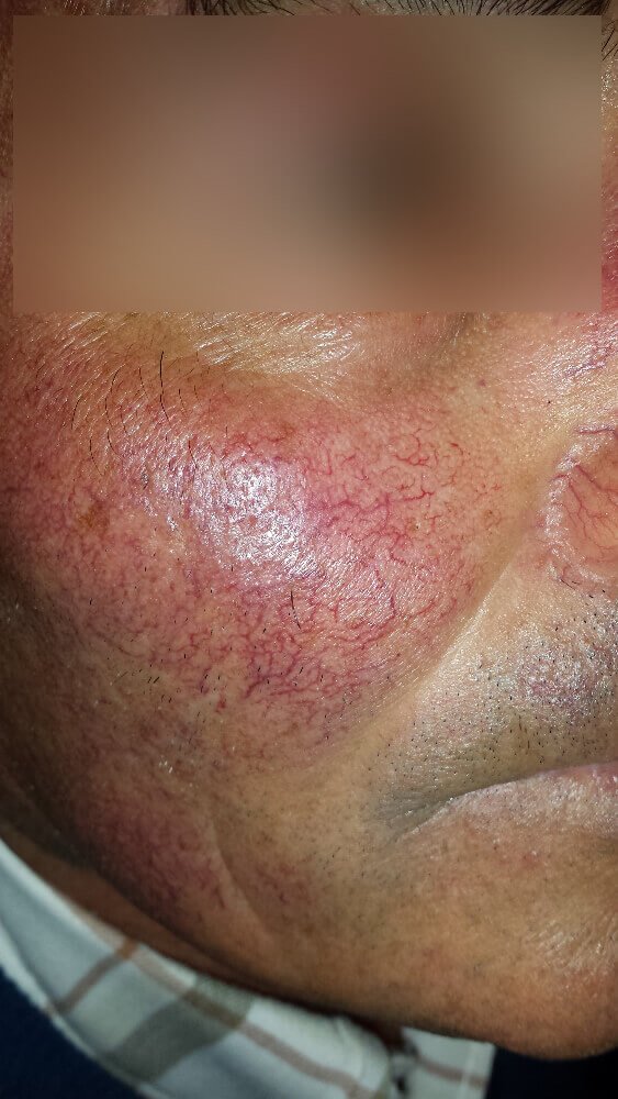 cura rosacea