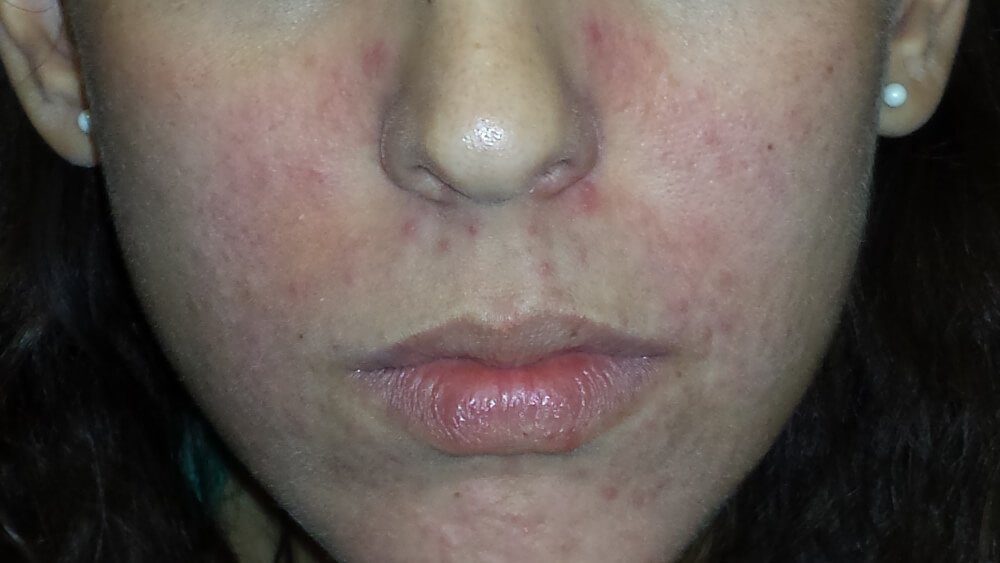 dermatologista rosacea