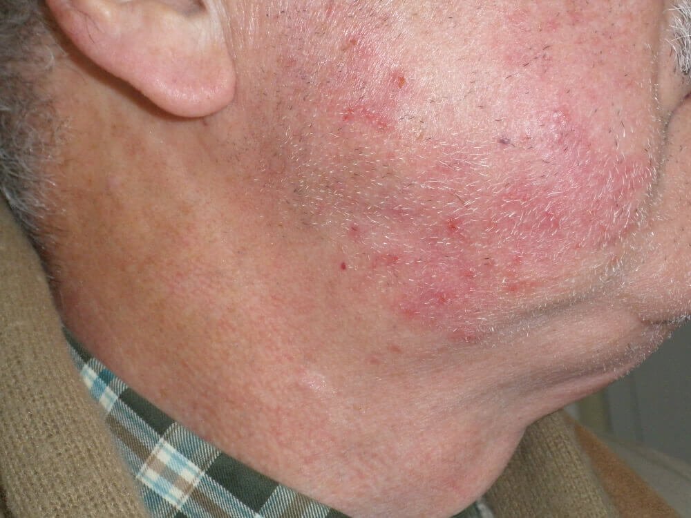 diagnostico rosacea